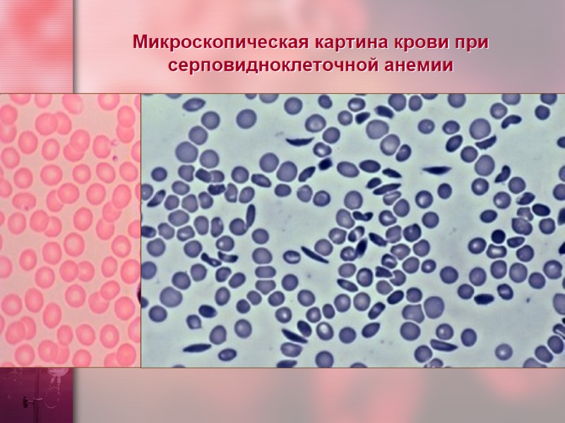 Микроскопическая картина крови при серповидноклеточной анемии